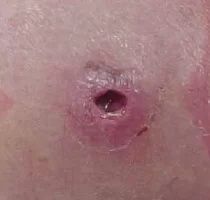 mrsa%u00252Bpicture%2B2.webp